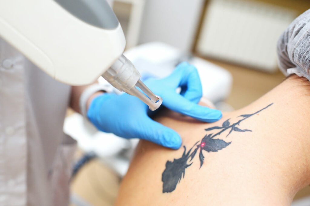 Láseres más comunes para eliminar tatuajes: Láser Picosegundo