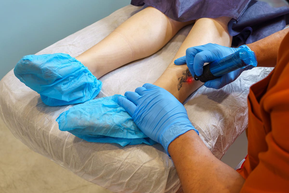 Imagen destacada de “Sesiones necesarias para eliminar un tatuaje: qué factores influyen”