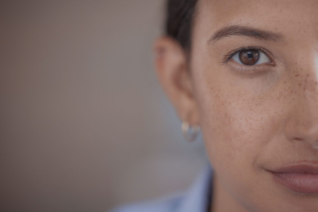 Micropigmentación de Pecas (Freckling)