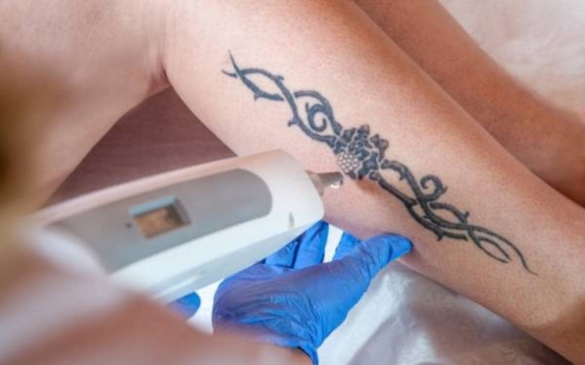 Imagen destacada de “El papel del láser Q-Switched en la eliminación profesional de tatuajes”