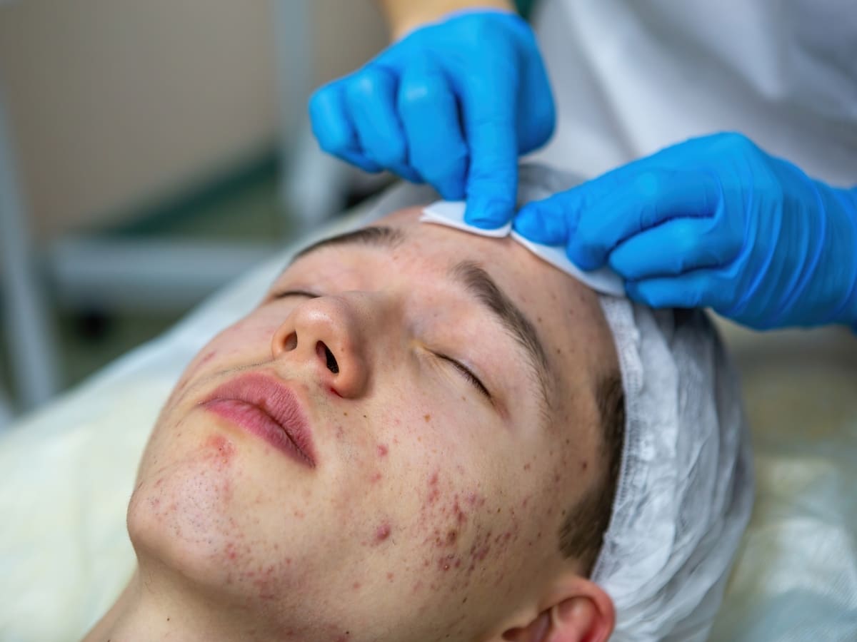 Imagen destacada de “Protocolo de higiene facial en pieles sensibles o con acné”